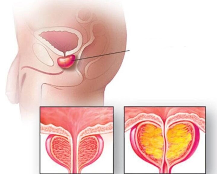 Umístění prostaty, normální prostata a zvětšená u chronické prostatitidy