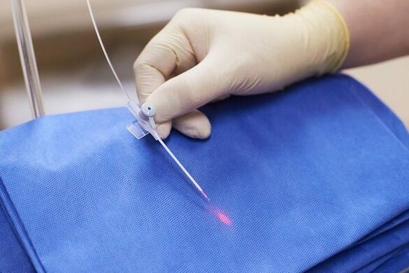 V některých případech se u chronické prostatitidy používá laserová terapie
