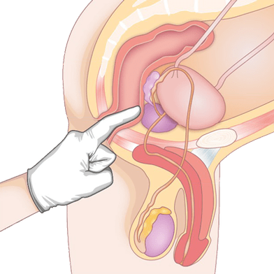 Stanovení stavu prostaty palpací pro diagnostiku prostatitidy