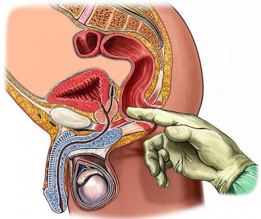 Diagnóza prostatitidy