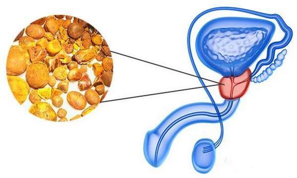 Problémy s prostatitidou