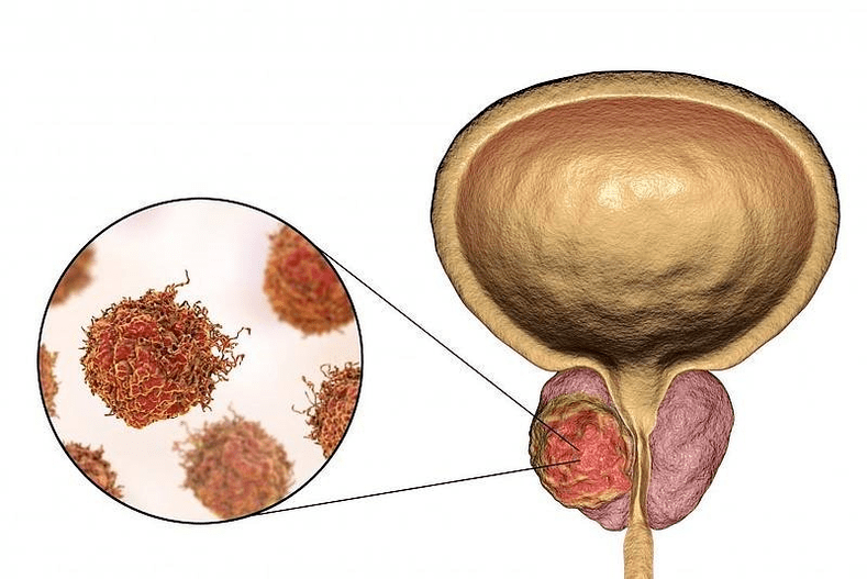 jak vypadá poškození prostaty