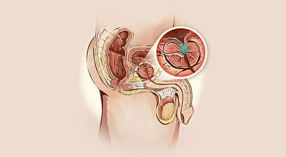 Prostata