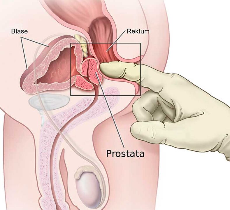 masáž prostaty pro prostatitidu