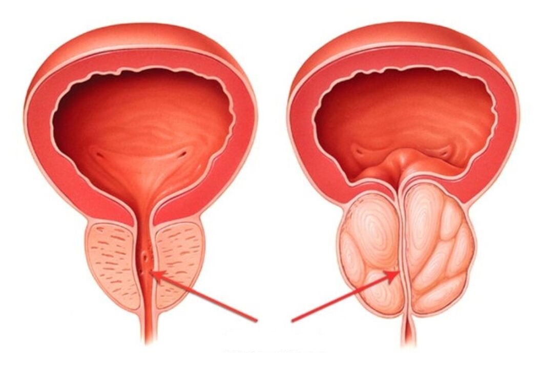 zdravá a zanícená prostata s prostatitidou