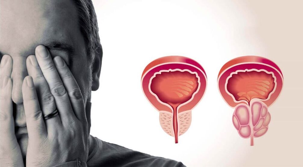 Zdravá a zanícená prostata